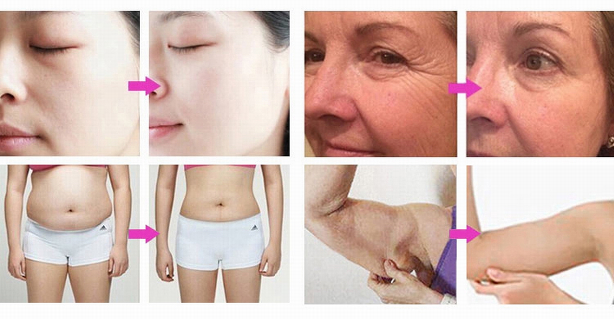 Ultrasonic Cavitation Machine